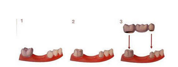 dental crown phuket