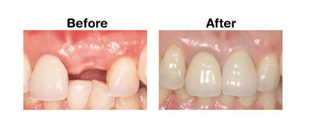 dental implants