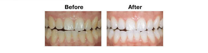 laser whitening teeth