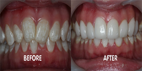 dental veneers phuket