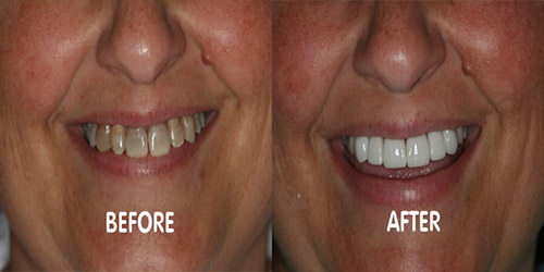 phuket dental veneers