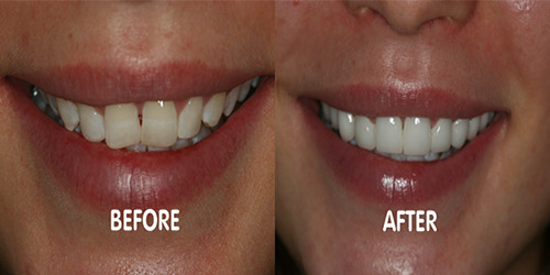 dental veneers