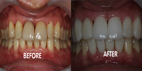 before after veneers